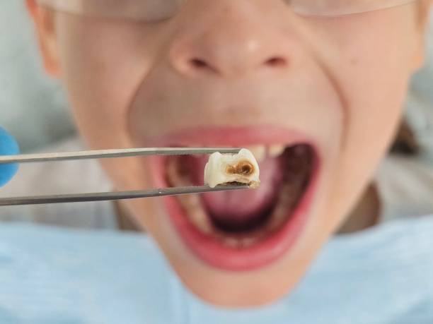 Best Emergency Root Canal Treatment in Hot Springs, SD